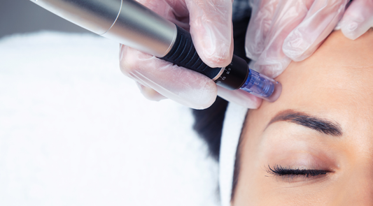 Microneedling on a client