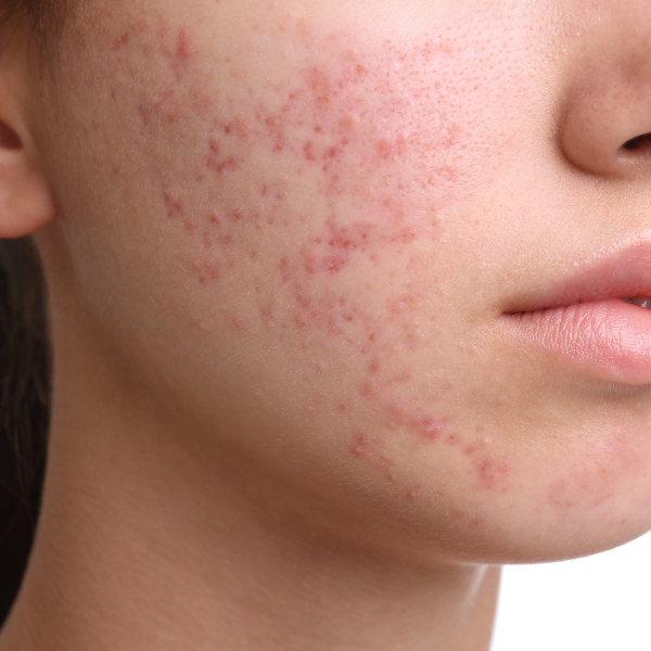 Close up of a woman's face with visible acne, showing inflamed pimples and red blemishes on her cheeks. Before acne treatment Nottingham.