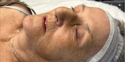 After Cooljet Plasma treatment