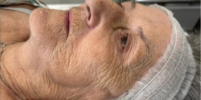 Before Cooljet Plasma treatment