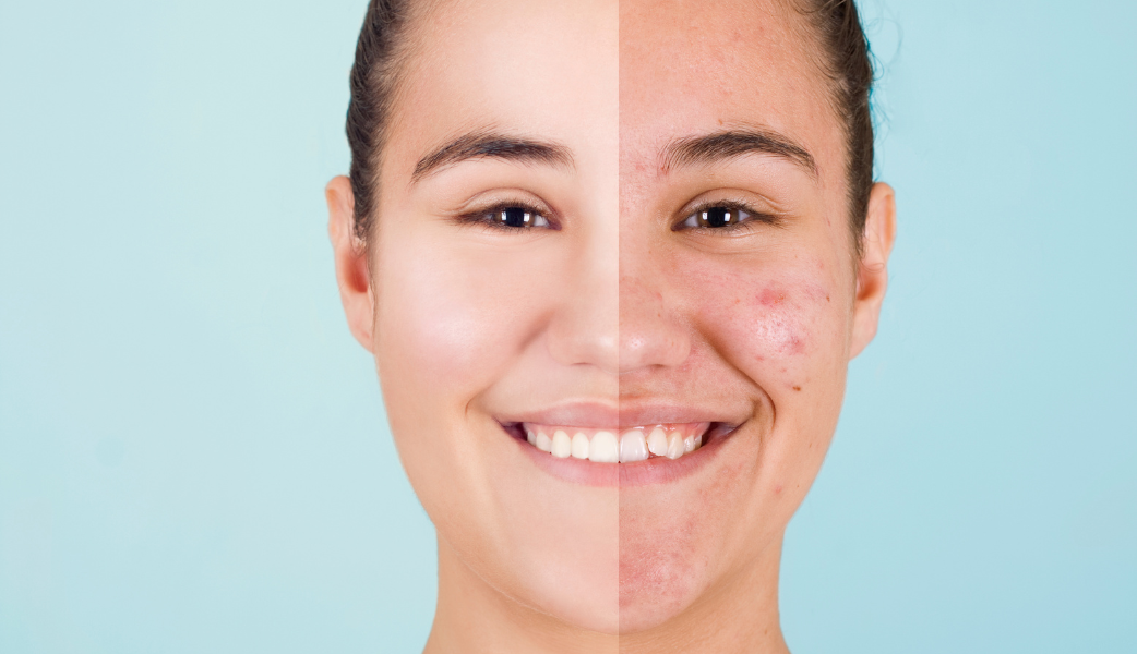 Front facing view of a lady on her left side with clear face after treatment and right side with eczema on her face