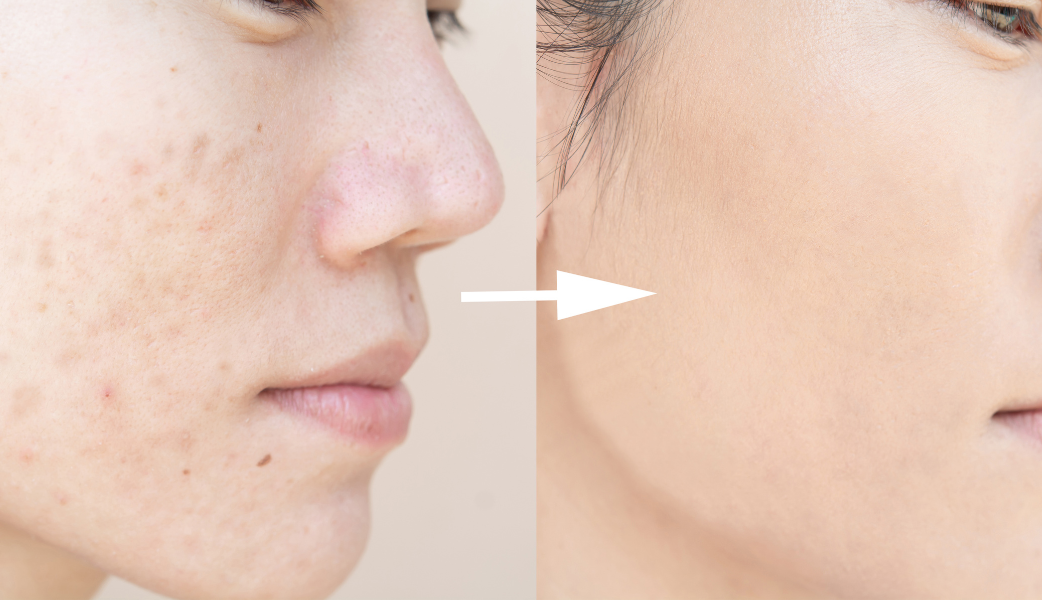 Before Treatment: A close up image of a young woman with significant acne on her forehead and cheeks, looking directly at the camera with a serious expression. Her skin shows redness and several blemishes.
After Treatment: A close-up image of the same woman smiling confidently after treatment, showcasing her clear and smooth skin with a natural glow. The redness and acne marks have significantly diminished.