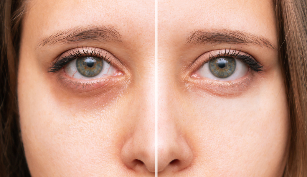 Before Treatment: A close-up image of a young woman with small white bumps (milia) under her eyes, looking concerned. The image highlights the texture of her skin, focusing on the milia’s appearance.
After Treatment: A close-up image of the same with clear skin, showing no visible signs of milia. Her complexion appears smooth and radiant, reflecting the effectiveness of the treatment.