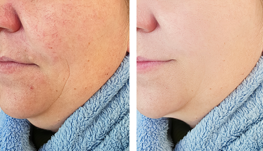 Before Treatment: A close up image of a woman with rosacea, showing red patches and visible blood vessels across her cheeks and nose. Her expression looks slightly concerned, and the redness on her skin is pronounced.
After Treatment: A close up image of the same woman with visibly reduced redness and even toned skin. The rosacea flare-up has subsided, and her complexion appears much smoother and calmer.