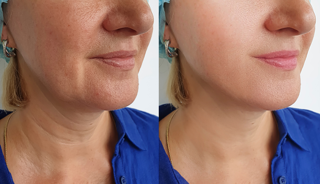 Before Treatment: A side profile of the woman displaying intense redness and irritation from rosacea along her cheeks and jawline, looking frustrated. The image emphasizes the inflamed, red areas of her skin.
After Treatment: A side profile of the same woman, now with clear, calm skin, smiling happily. The redness and irritation are gone, and her skin looks smooth and healthy, showcasing the effective results of the rosacea treatment.