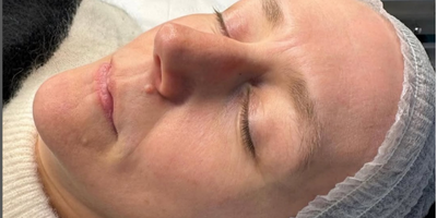 Before bespoke facial treatment