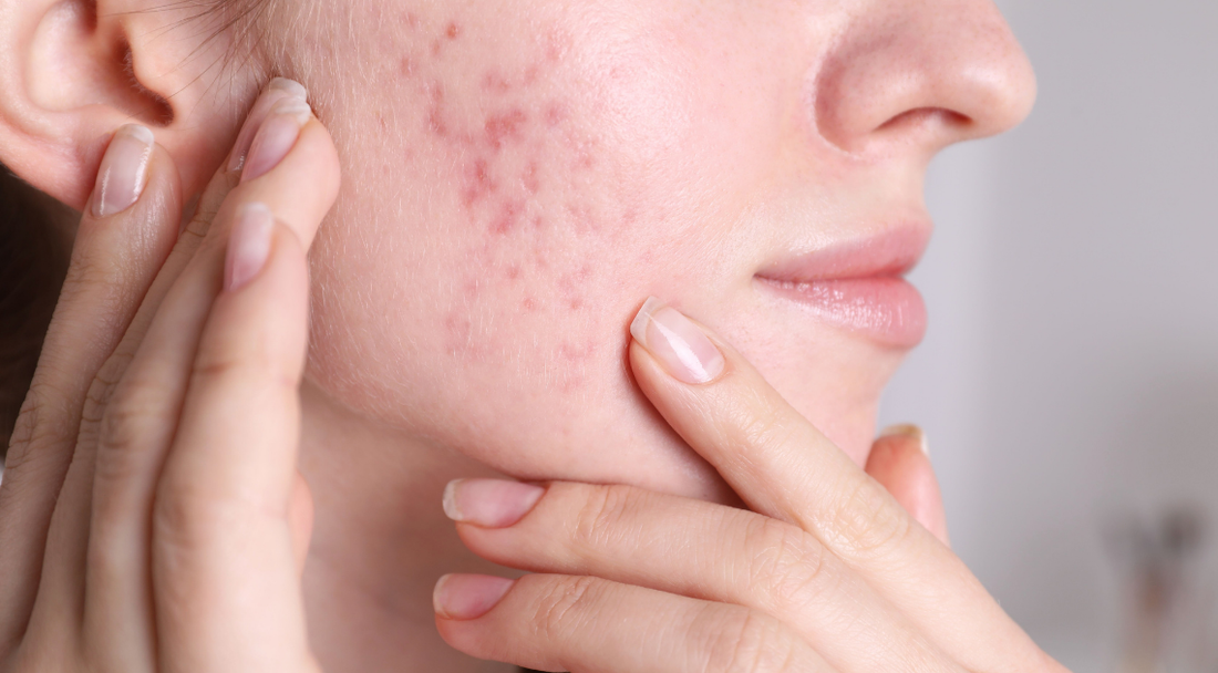 Close-up of a person gently touching their cheek, showing visible acne scars and redness on the skin.